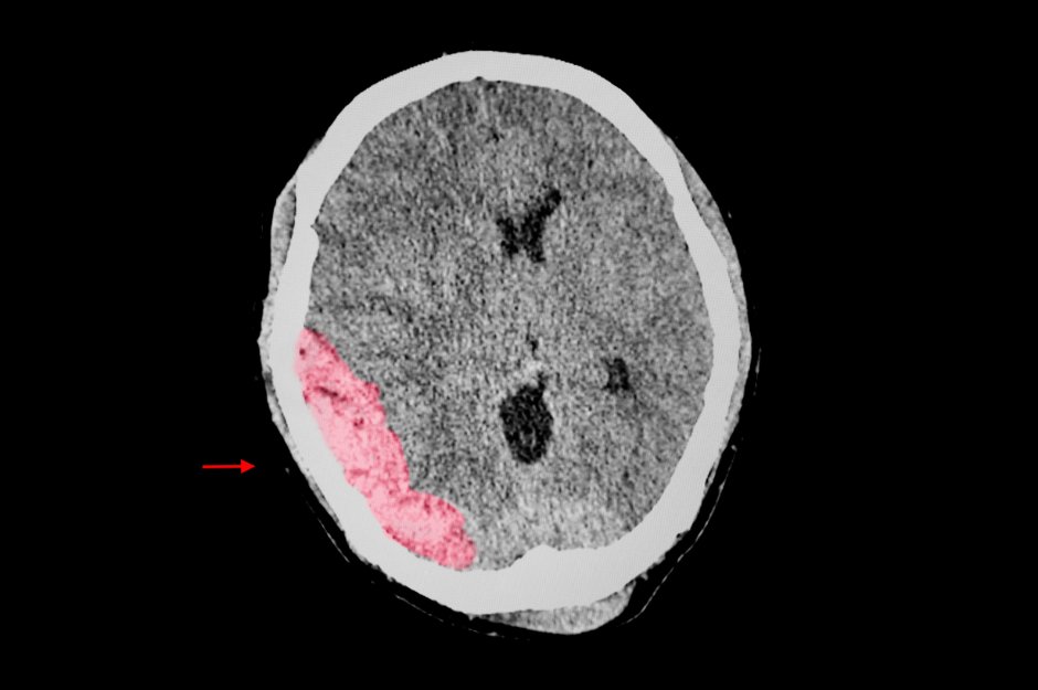 BreslinLaw's tweet photo. Traumatic brain injuries (TBIs) can cause profound and life-changing damage to a person, but the symptoms may be hard to spot. In next month’s newsletter, we'll share tips for recognizing the common causes and symptoms of a TBI. Subscribe now for free: https://t.co/lEKUk9T9YE https://t.co/la8AARXXkq
