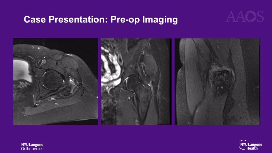 AAOS (@aaos1) on Twitter photo Celebrating the #AAOS2025 #OVT Award Winners! #GluteusMaximus Tendon Transfer for Chronic #Abductor Insufficiency: bit.ly/3Y362nk
Submit your video for #AAOS2026 at video.aaos.org today!
<a href="/nyulangone/">NYU Langone Health</a> <a href="/nyulangoneortho/">NYU Langone Orthopedics</a> @dylanlowemd <a href="/lomasortho/">Guillem Gonzalez-Lomas MD</a>
#OVTFridays #CME Celebrating the #AAOS2025 #OVT Award Winners! #GluteusMaximus Tendon Transfer for Chronic #Abductor Insufficiency: bit.ly/3Y362nk
Submit your video for #AAOS2026 at video.aaos.org today!
<a href="/nyulangone/">NYU Langone Health</a> <a href="/nyulangoneortho/">NYU Langone Orthopedics</a> @dylanlowemd <a href="/lomasortho/">Guillem Gonzalez-Lomas MD</a>
#OVTFridays #CME