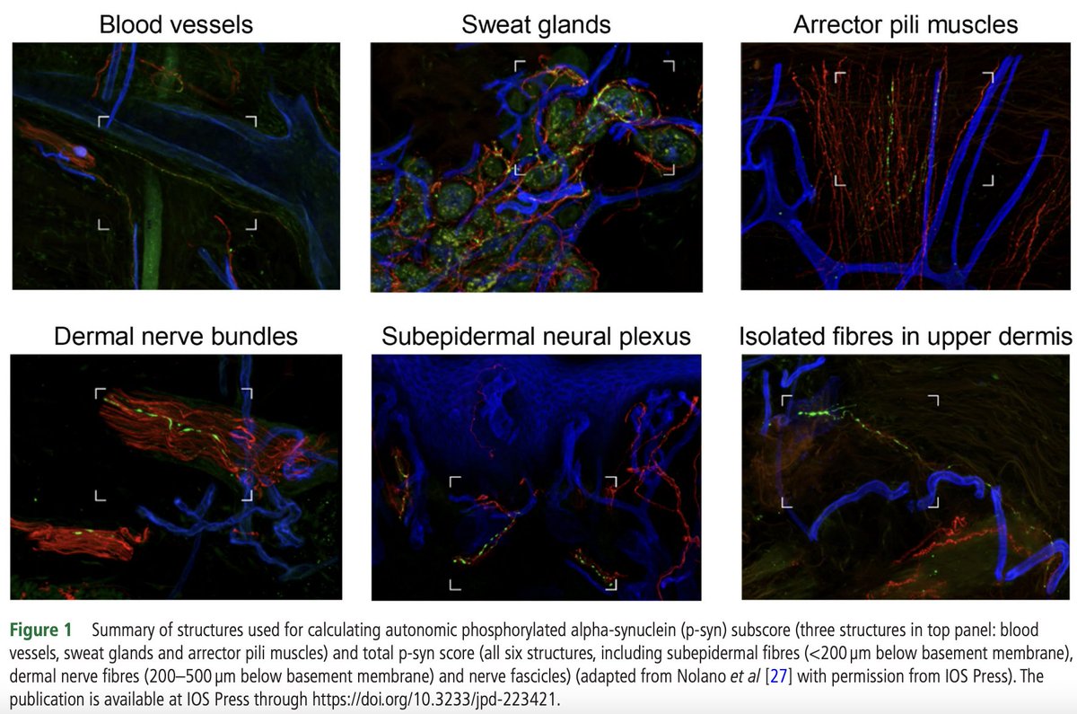 Koay et al demonstrated that a simple semiquantitative #score for cutaneous #phosphorylated-synuclein deposition on #autonomic nerves is a very sensitive #biomarker for the early #diagnosis &amp; distinction between #PAF, non-synuclein-related autonomic failure, and #MSA.