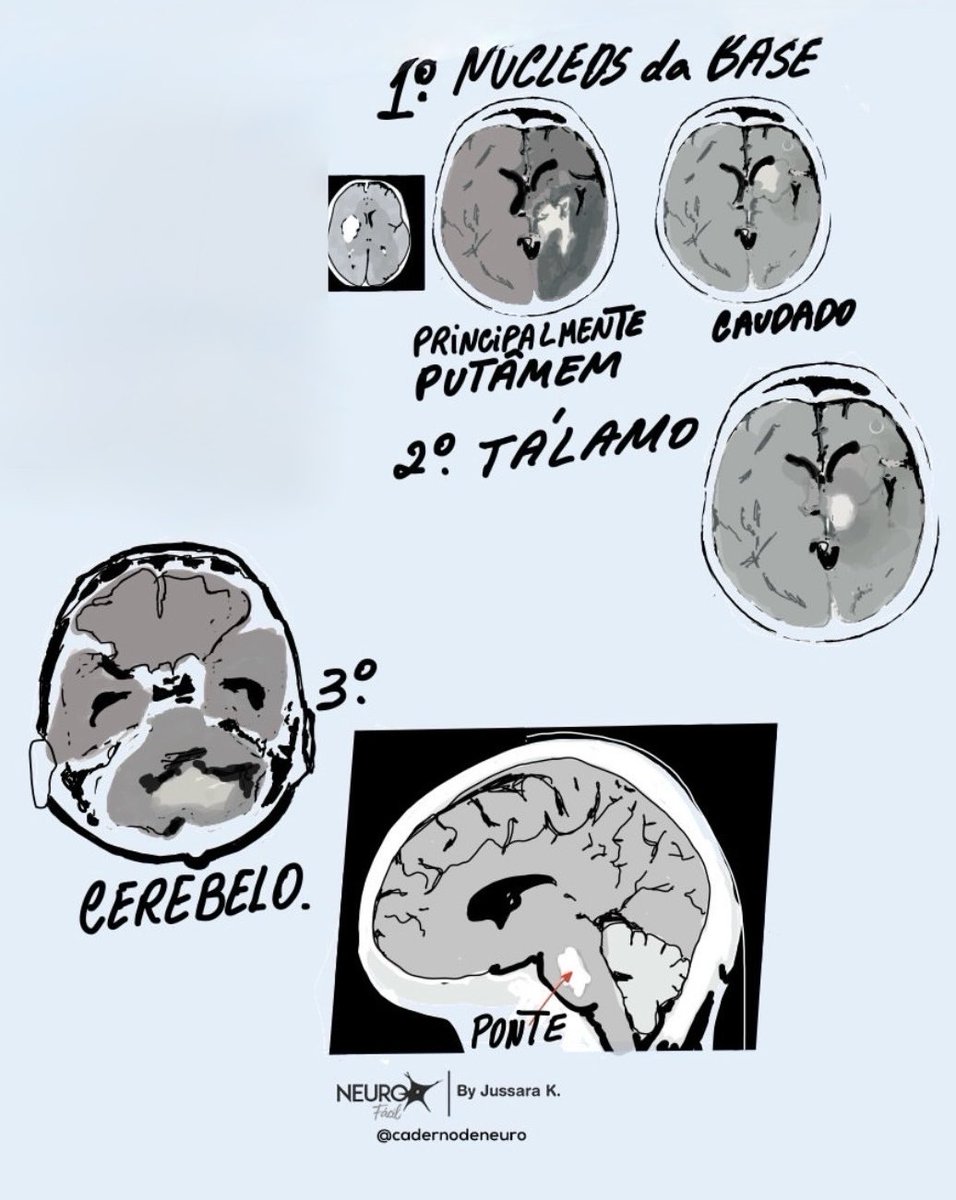 Hypertensive bleeds 
Basal ganglia &gt; thalamus&gt; cerebellum &gt; pons