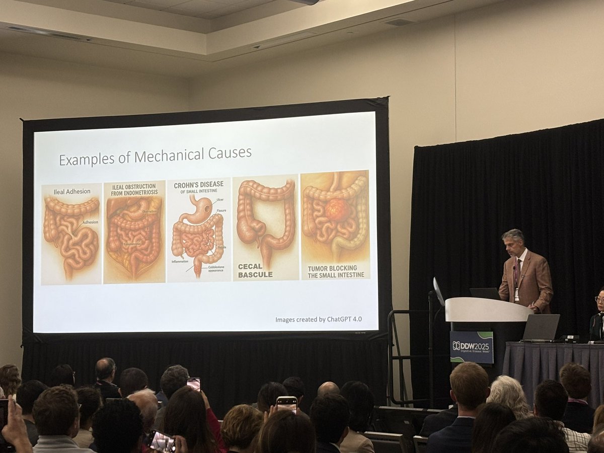 IBDPassport's tweet photo. Great presentation on SIBO
➡️Identify the underlying cause 
➡️Test the right gas  
➡️Beware of false negatives
➡️44% of patients respond to Rifaxamin 
➡️Diet Inc. Elemental can help
➡️Prokinetic Tegaserod at night helps with IBS -D
➡️Targeted therapies on the horizon - Don't miss  session SU2010 Sunday 4th 12.30pm

.
#DDW2025 @MarkPimentelMD @MountSinaiNYC #SIBO #SIBOTREATMENT #IBS #microbiome #MedTwitter @chusmillan85 @john_damianosMD @KewinSiah @EmeranMayerMD @robinberlinrd