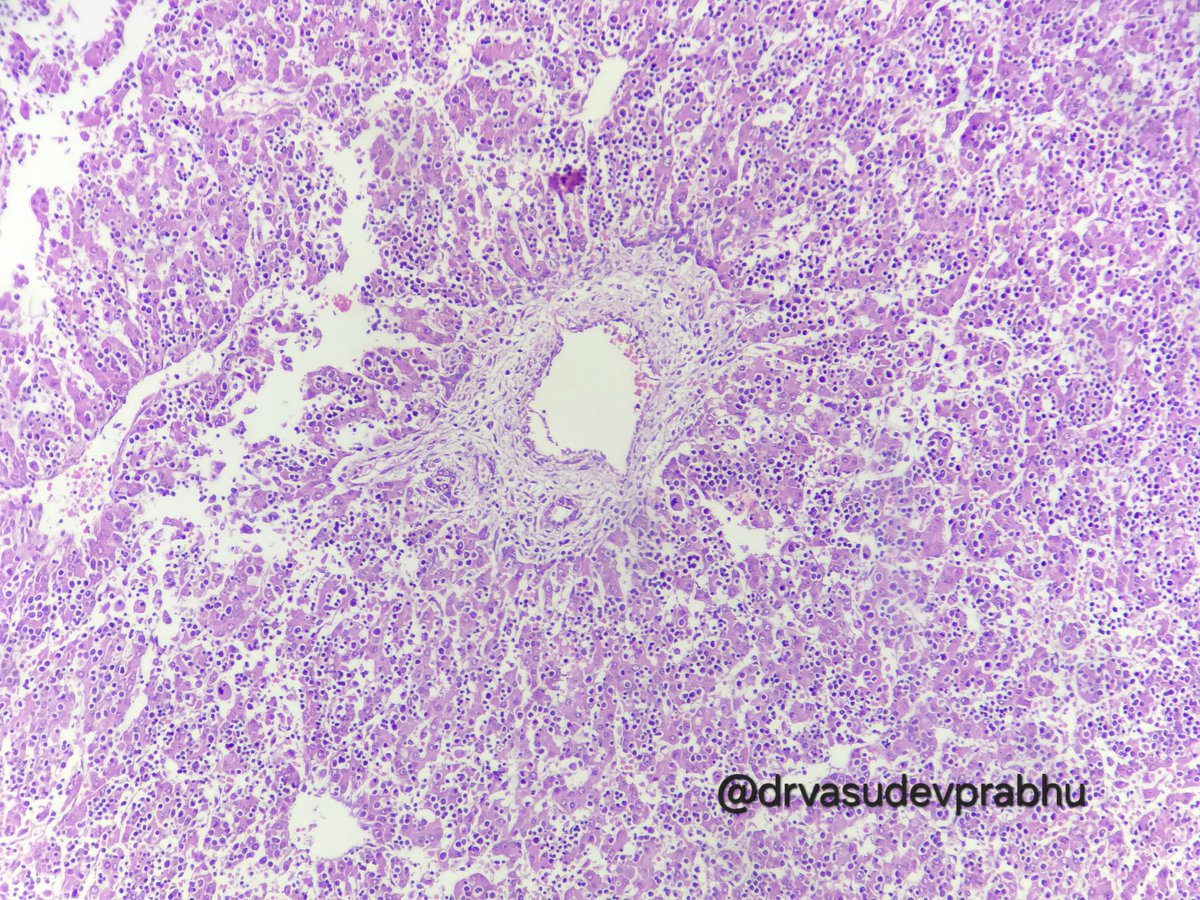 Vasudev Prabhu🇮🇳 (@drvasudevprabhu) on Twitter photo Can you tell what this is from this far🤓😬🔬? #spotter #pathology #pathX #PathTwitter #MedTwitter #pathX #pathologyresidents <a href="/anjuthevirgo/">Anju Pandey</a> <a href="/DrCycloPath/">Charlie Herndon</a> <a href="/pkmadridista/">Dr. Pinakin Kaushik (MD Dip.RCPath)</a> <a href="/ArvindKhanijo/">Arvind Khanijo</a> <a href="/premcharles/">Prem Charles</a> Can you tell what this is from this far🤓😬🔬? #spotter #pathology #pathX #PathTwitter #MedTwitter #pathX #pathologyresidents <a href="/anjuthevirgo/">Anju Pandey</a> <a href="/DrCycloPath/">Charlie Herndon</a> <a href="/pkmadridista/">Dr. Pinakin Kaushik (MD Dip.RCPath)</a> <a href="/ArvindKhanijo/">Arvind Khanijo</a> <a href="/premcharles/">Prem Charles</a>