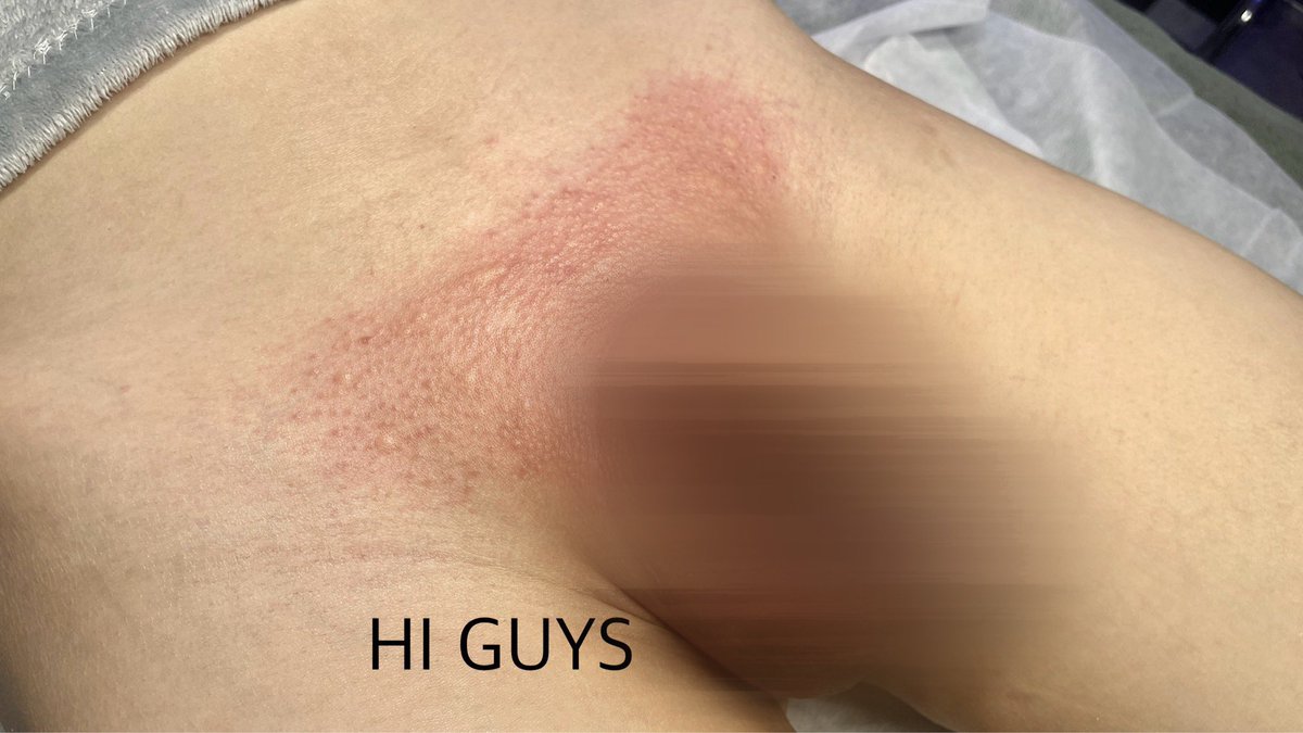 [하이가이즈 왁싱]

남자몸은 남자가 잘알죠!😗
남자 브라질리언 왁싱(고급)

남성전용 왁싱 네이버예약⬇️
naver.me/GKUxX6OD

 #남자왁서 #남자왁싱 #남성전문왁싱샵 #군자왁싱 #건대왁싱 #하이가이즈왁싱 #남자브라질리언왁싱