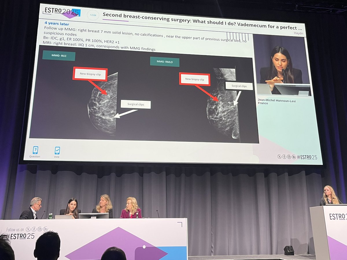 Donjeta Zeqa (@donjetazeqa) on Twitter photo “Second breast-conserving surgery: What should I do? Vademecum for a perfect multidisciplinary meeting”
It was such a great pleasure to be involved in the “Multidisciplinary Tumour Board” at #ESTRO25 alongside
<a href="/HannounJean/">jean-michel hannoun-levi</a> <a href="/KaidarOrit/">orit Kaidar-person</a> <a href="/itrisabel/">IR</a>❤️
<a href="/ESTRO_RT/">ESTRO</a> “Second breast-conserving surgery: What should I do? Vademecum for a perfect multidisciplinary meeting”
It was such a great pleasure to be involved in the “Multidisciplinary Tumour Board” at #ESTRO25 alongside
<a href="/HannounJean/">jean-michel hannoun-levi</a> <a href="/KaidarOrit/">orit Kaidar-person</a> <a href="/itrisabel/">IR</a>❤️
<a href="/ESTRO_RT/">ESTRO</a>