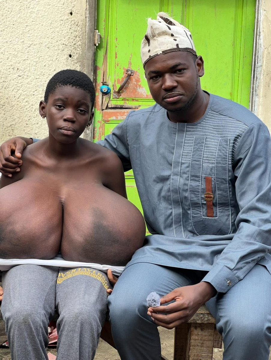 lemedia100filtr's tweet image. 🚨🇧🇫 URGENT – APPEL À SOLIDARITÉ
Bénédicte, une élève de 13 ans en classe de 5e, souffre d’une grave tumeur au niveau de la poitrine qui l’empêche de dormir, de se tenir debout et l’a contrainte à abandonner l’école.
Son opération, vitale et urgente, coûte 1 000 000 F CFA, mais…