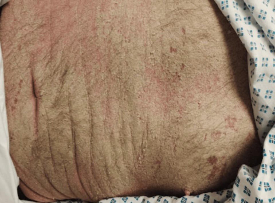 anatomie_pro's tweet photo. Er kam mit Hautausschlag. Drei Tage später war er tot.

Norwegische Krätze – voller Milben, hochinfektiös.
Fehldiagnose, Organversagen, septischer Schock.

Ein Ausschlag wurde sein Todesurteil. https://t.co/lA2ULzcPLg
