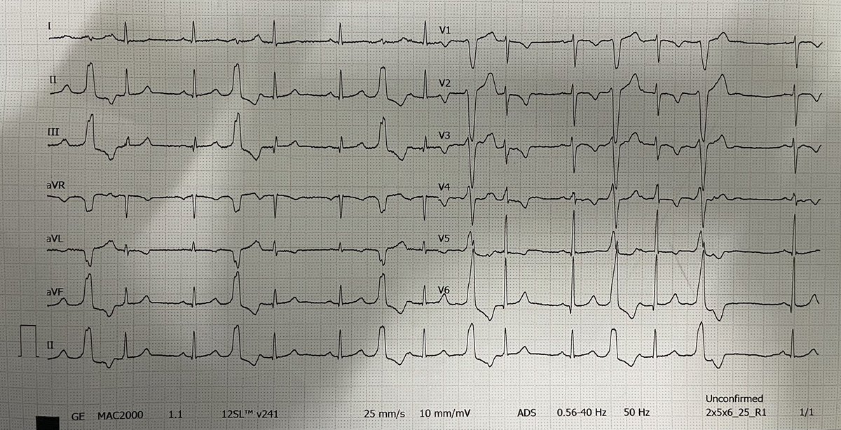 MN_Ismail's tweet photo. 16 yo F with syncope. https://t.co/4XBubbvVBp