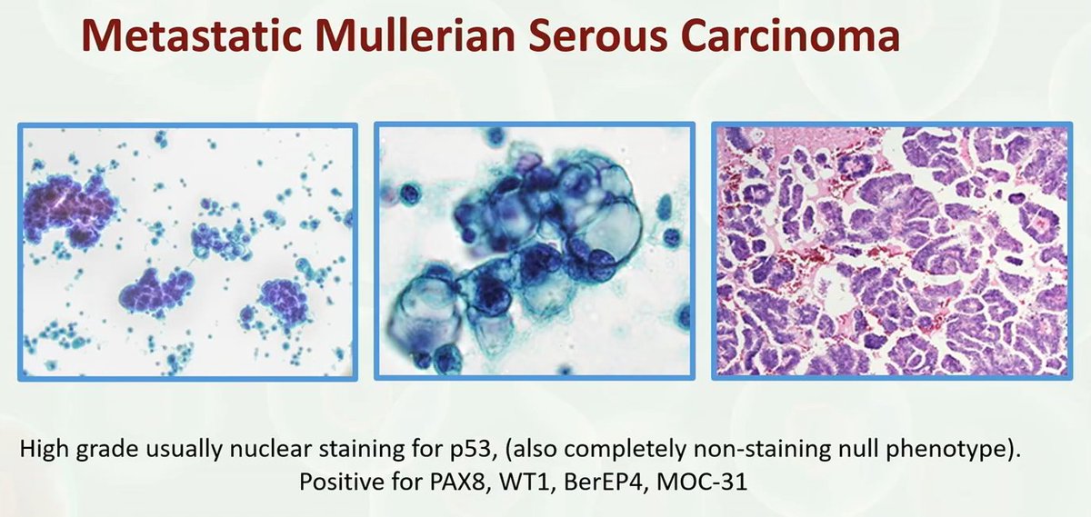 Cytology
Metastatic Mullerian Serous Carcinoma

Dr. Siddiqui #USCAP25 #PathX #pathology #PathBoards