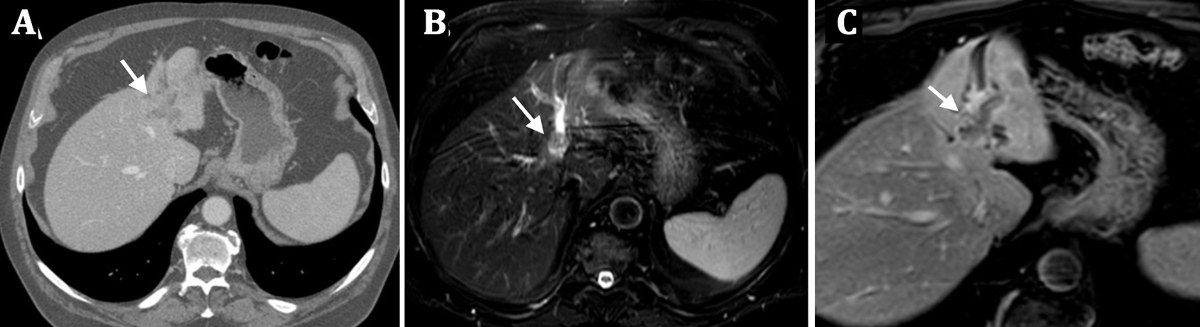 MedBlend (@medblendpub) on Twitter photo #Sunday_Vignette ๐ฉบ
62F w/ jaundice, pruritus, weight loss.
Dx?
๐ง Answer โก๏ธ medblendpublishing.com
<a href="/Dx_imaging/">Diagnostic Imaging</a> <a href="/ACOREdu/">Academy of Online Radiology Education</a> <a href="/AbdominalCase/">Abdominal Radiology Case Conference</a> <a href="/radRounds/">radRounds Radiology Network</a> <a href="/radiologistpage/">theRadiologist</a>
#Radiology #CaseOfTheDay #LiverTumor #Ultrasound #CT #MRI #MedicalImaging #Radres #Hepatology #DxRadiology #Sunday_Vignette ๐ฉบ
62F w/ jaundice, pruritus, weight loss.
Dx?
๐ง Answer โก๏ธ medblendpublishing.com
<a href="/Dx_imaging/">Diagnostic Imaging</a> <a href="/ACOREdu/">Academy of Online Radiology Education</a> <a href="/AbdominalCase/">Abdominal Radiology Case Conference</a> <a href="/radRounds/">radRounds Radiology Network</a> <a href="/radiologistpage/">theRadiologist</a>
#Radiology #CaseOfTheDay #LiverTumor #Ultrasound #CT #MRI #MedicalImaging #Radres #Hepatology #DxRadiology