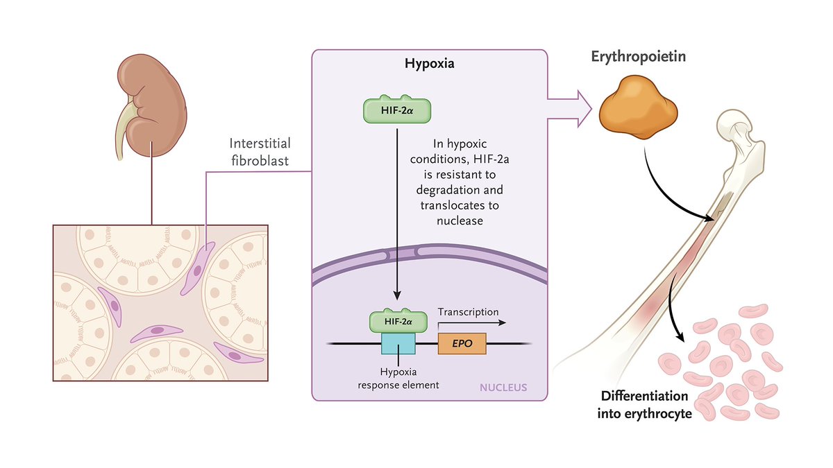 𝐄𝐫𝐲𝐭𝐡𝐫𝐨𝐩𝐨𝐢𝐞𝐭𝐢𝐧 is a glycoprotein hormone that is produced by the kidney in response to hypoxia. It stimulates the production of red cells in the bone marrow and thereby increases oxygen delivery to tissues. Synthetic, injectable erythropoietin can be administered