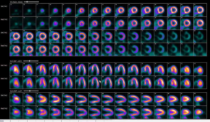 MariaAlwan_'s tweet photo. 💡True apical defect or apical thinning?
Check reversibility:
• Reversible➡️ischemia
• Fixed➡️check gated images
– Preserved apical contraction→ thinning
– Defect resolves with myocardial thickening in ES→ thinning
⬅️Thinning |True defect➡️
@MyASNC @almallahmo @edwardmillermd https://t.co/17xb9Xe7YM