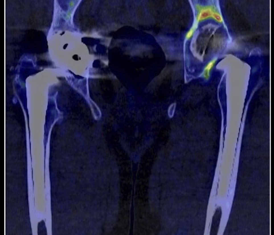 18F-fluoride PET/CT 

⬆ uptake around loose (cf well-fixed components) in all but femoral TKA components (n=63) <a href="/Clinorthop/">CORR</a> 

#hipreplacement #kneereplacement #revision buff.ly/paDOyEK