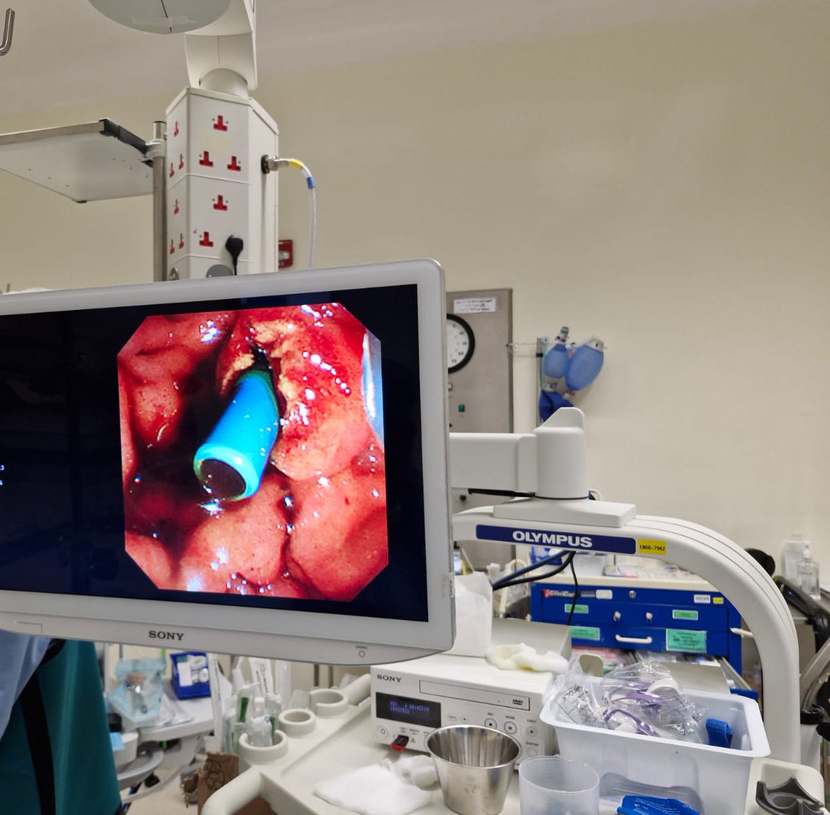 في إطار التعاون بين المدينة الطبية الجامعية <a href="/UMC_OMAN/">المدينة الطبية الجامعية</a> - مستشفى جامعة السلطان قابوس ووزارة الصحة <a href="/OmaniMOH/">وزارة الصحة - سلطنة عُمان</a> مستشفى السلطان قابوس في صلالة، قمتُ بإجراء منظار للقنوات الصفراوية لمريض يبلغ من العمر 24 سنة، وذلك بعد إصابته بحادث سيارة أدى إلى تسرّب في القنوات الصفراوية.

بعد الانتهاء