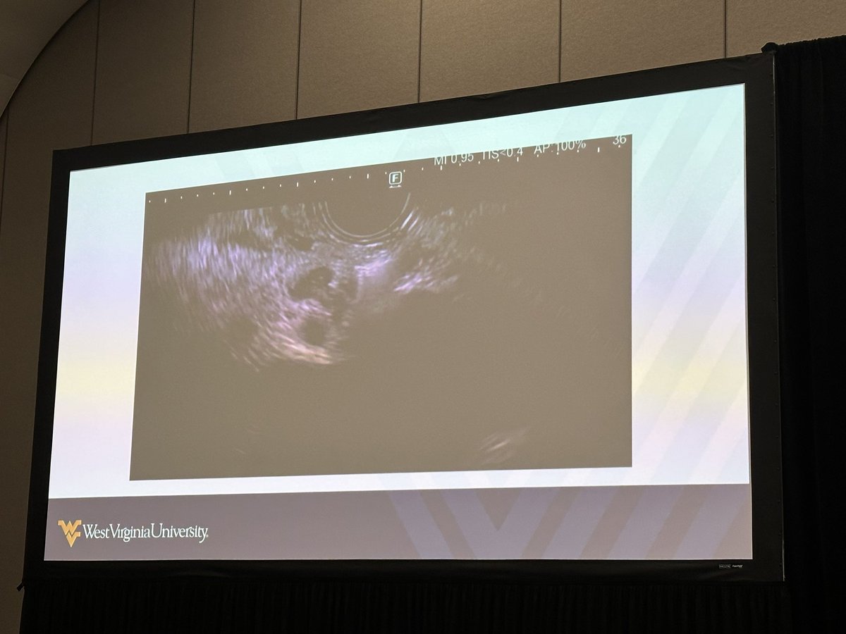 VibhuC_MD's tweet image. Continued innovation @WVU_GI thanks to the strong work of @shailsingh for spearheading an alternative non-opioid pain 💊 mgmt option for pancreatic cancer with EUS-guided RFA ⚡️celiac plexus neurolysis with promising efficacy and safety profile. @ShyamTMD @SkipKrafftMD #DDW2025