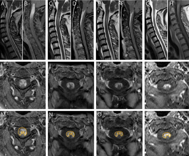 🔱Do you know in which conditions the trident sign appears on spinal MRI?

🙃And what if I told you this patient showed a reversed trident sign, with ventral rather than dorsal enhancement, along with subacute paraparesis and urinary retention?

👉What would you suspect?