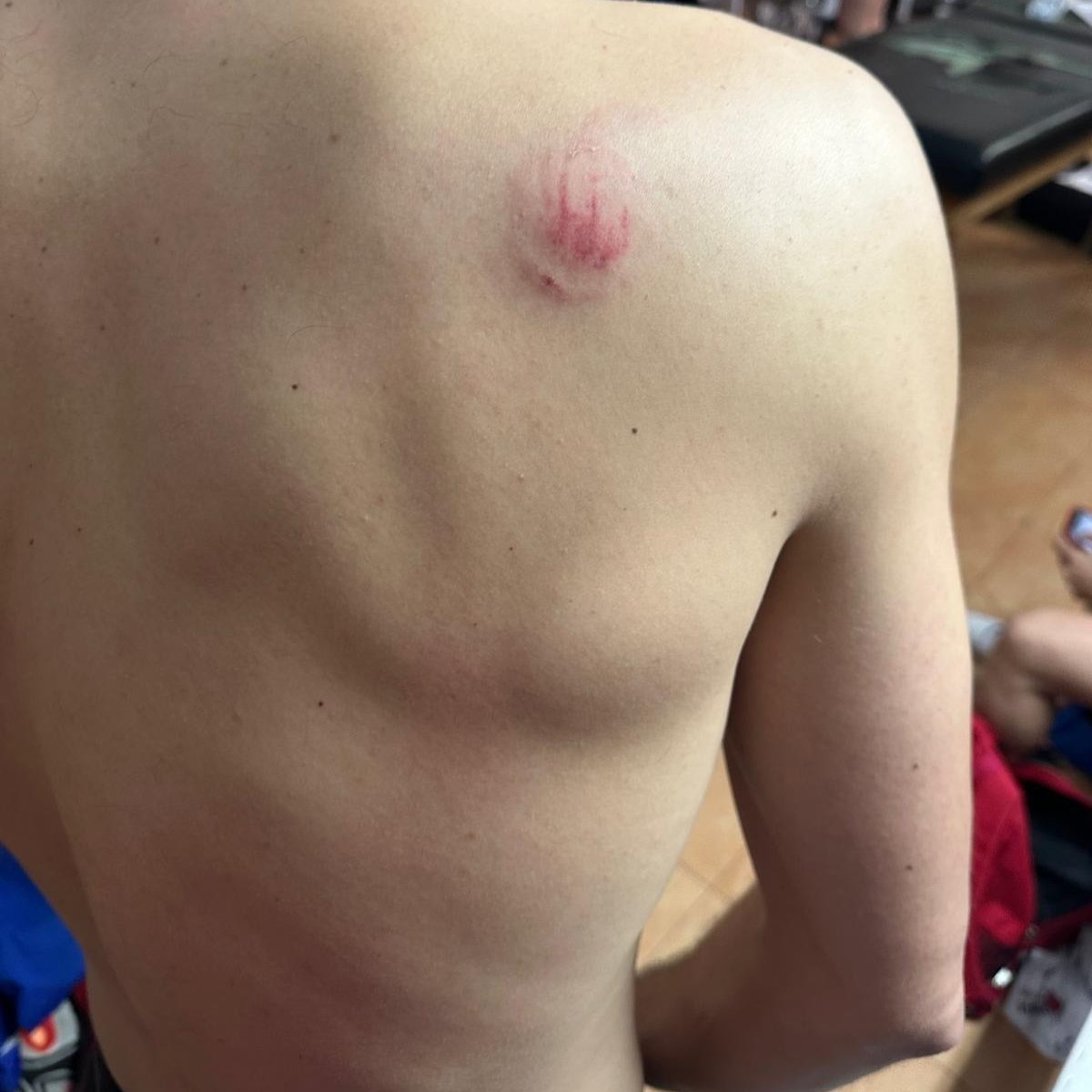 Hoy el árbitro del <a href="/SportingAlcazar/">EMERS Sporting de Alcázar C.F.</a> vs <a href="/AtlTomelloso/">Atlético Tomelloso 💛💚</a> no expulsó a un jugador por dar un bocado a un compañero de deporte pero rival en el campo. Al sacarle amarilla y no reflejarlo en el acta no se ha podido denunciar ante la policía esta agresión.

Séptima categoría. Cutreces.