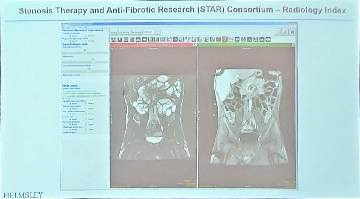 Michael Chiorean (@mchiorean4) on Twitter photo The #fibrosis guru, Dr <a href="/IBD_FloMD/">Florian Rieder</a> on the present and future of medical management for fibrotic strictures in #IBD #crohnsdisease; promising pipeline; define disease (28 historic definitions for strictures🤪), and target, identify endpoints (PRO, imaging), design & finish study The #fibrosis guru, Dr <a href="/IBD_FloMD/">Florian Rieder</a> on the present and future of medical management for fibrotic strictures in #IBD #crohnsdisease; promising pipeline; define disease (28 historic definitions for strictures🤪), and target, identify endpoints (PRO, imaging), design & finish study