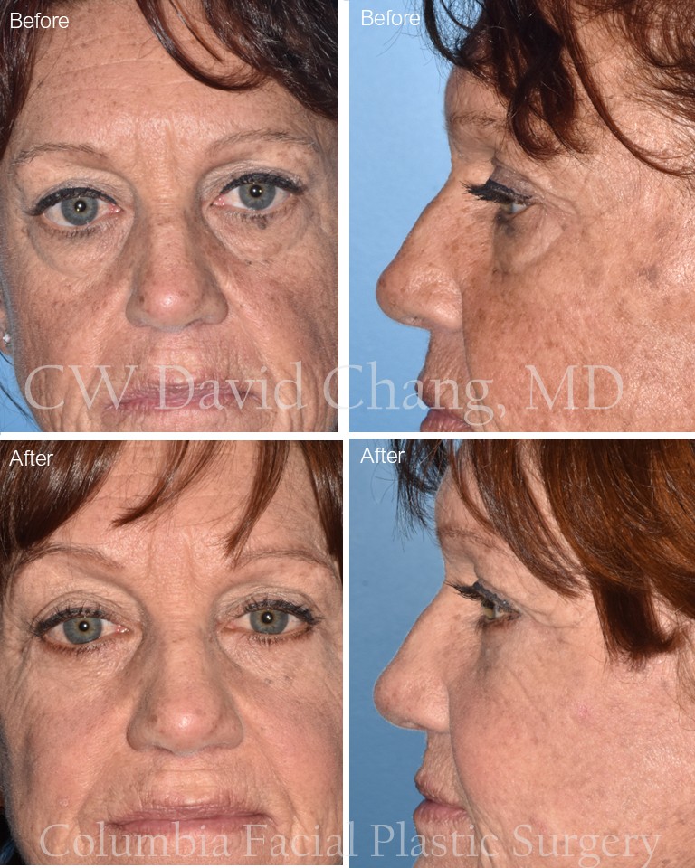 Tired of looking tired? Lower eyelid fat-repositioning #blepharoplasty uses your own natural fat to smooth out under-eye hollows and reduce the appearance of dark circles. By redistributing this fat, we restore youthful volume and soften those deep tear troughs. #plasticsurgery