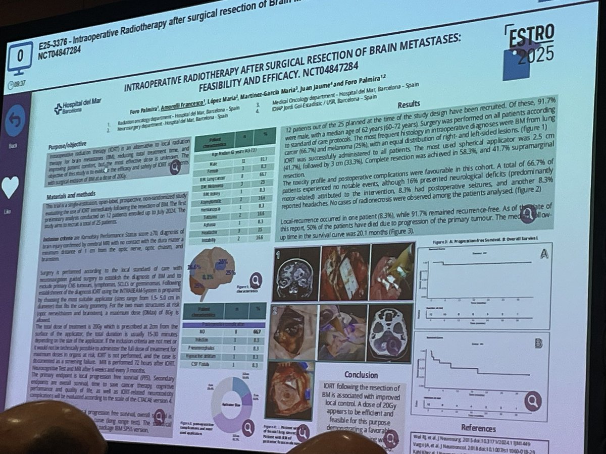 abraocantoMD's tweet photo. Phase II trial IORT post-resection of brain metastases shows promising local control with 20 Gy. Among 12 patients, recurrence was 8.3% (subtotal resection), no radionecrosis observed. IORT appears effective and safe with favorable toxicity

@fgamorelli #ESTRO25 https://t.co/MllL53N5vd