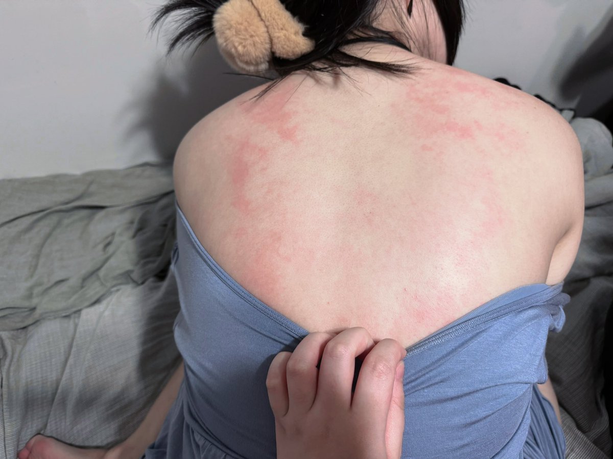 朋友來家裡
聽我說最近很累，幫我拍打我的背

友：這個跟刮痧一樣，你看妳的背好紅喔

：幹好痛

我的皮膚真的很容易有紅印或痕跡耶
上次觀眾看我腿上的腿帶拿下來後痕跡也一直沒消過 https://t.co/BFOo3KIyvk