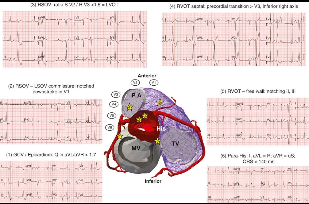 PVC localization on ECG.
Premature ventricular complexes (PVCs) are early depolarizations originating from the ventricles, bypassing the His-Purkinje system.

This powerful image illustrates PVCs from different anatomical origins➡️outflow tracts (RVOT/LVOT) and the tricuspid