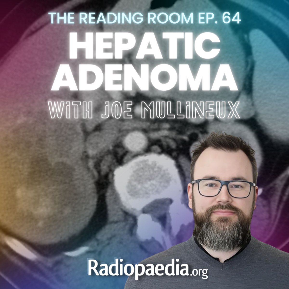 Andrew Dixon (@drandrewdixon) on Twitter photo Ep 64 is out! <a href="/DrVikasShah/">(𝚝𝚑𝚎𝚡𝚛𝚊𝚢𝚍𝚘𝚌𝚝𝚘𝚛)</a> & Joe Mullineux break down hepatic adenomas; an update on subtypes & characteristics. Plus: X-Boost, pineapples, Minecraft & an MRI-inspired symphony!
Apple: podcasts.apple.com/us/podcast/the…
Spotify: open.spotify.com/show/6iQe9v7Tc…
YouTube: youtube.com/playlist?list=… Ep 64 is out! <a href="/DrVikasShah/">(𝚝𝚑𝚎𝚡𝚛𝚊𝚢𝚍𝚘𝚌𝚝𝚘𝚛)</a> & Joe Mullineux break down hepatic adenomas; an update on subtypes & characteristics. Plus: X-Boost, pineapples, Minecraft & an MRI-inspired symphony!
Apple: podcasts.apple.com/us/podcast/the…
Spotify: open.spotify.com/show/6iQe9v7Tc…
YouTube: youtube.com/playlist?list=…