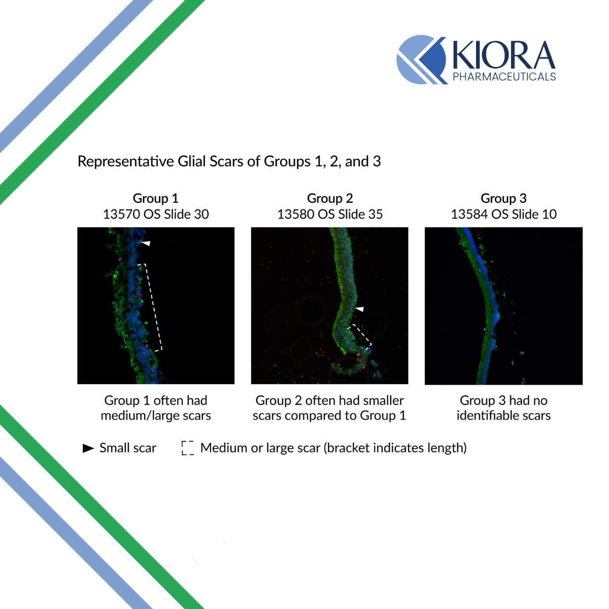 $KPRX - At ARVO 2025, we announced preclinical results demonstrating KIO-104 significantly reduced scar formation in an in vivo model of PVR. The findings further support KIO-104 as a promising candidate for inflammatory and proliferative retinal diseases. ir.kiorapharma.com/news-events/ne…