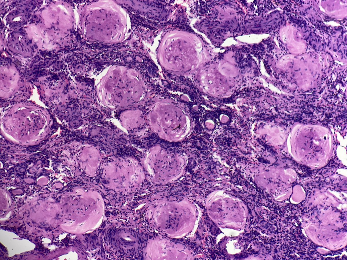 drsanjeev1981's tweet image. Sclerosed glomeruli 
In chronic pyelonephritis 
#MonFunctioningKidney 
#ChronicPyelonephritis 
#Nephropath #Pathology #Histopathology #Kidney
