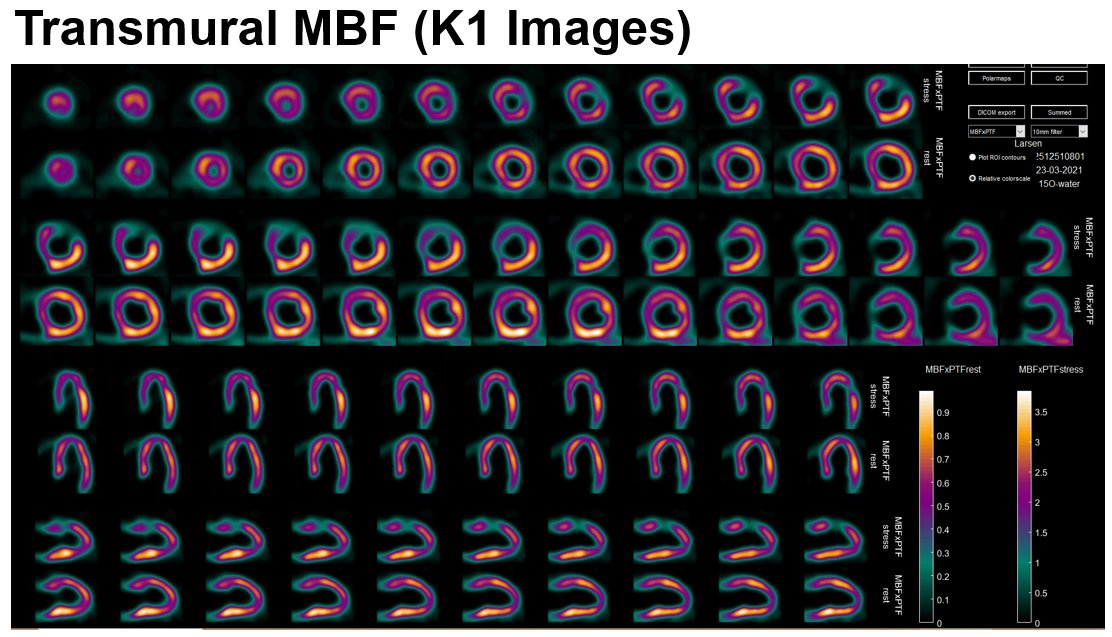 MyASNC's tweet image. New #CVNuc #ThinkPET case poll:  69-year-old male with known CAD and chest pain underwent adenosine 15O- H2O PET. What is your interpretation? Vote below.