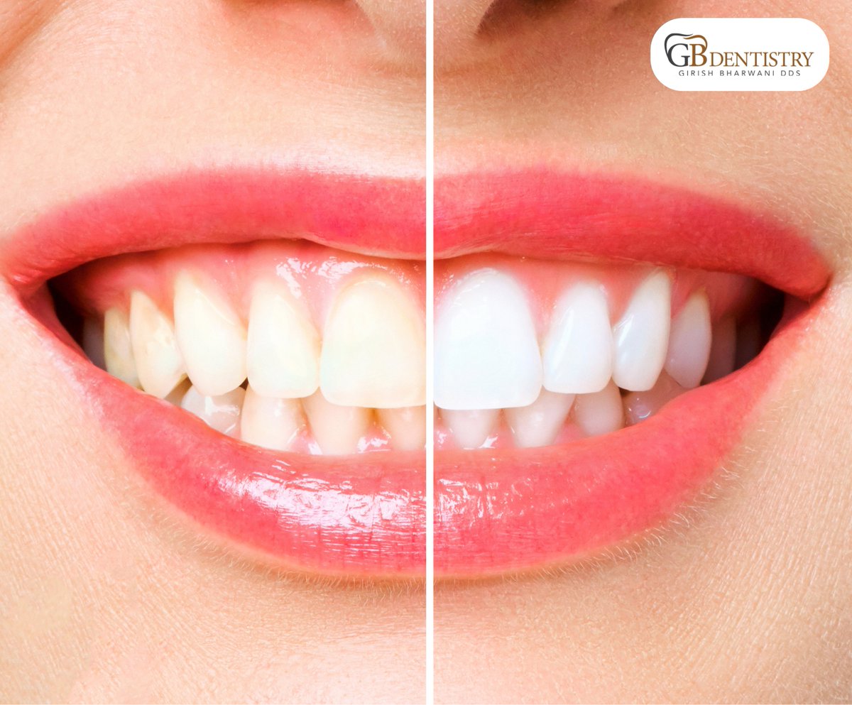 gbdentistry's tweet photo. Say goodbye to dull, stained teeth and hello to a brighter, more confident smile! Professional teeth whitening at GB Dentistry in Memorial is faster than you think. Ready for a transformation?
Book today: https://t.co/4F8zgdRpLs
#TeethWhitening #HoustonSmiles #MemorialTX https://t.co/f7bQ789RiQ