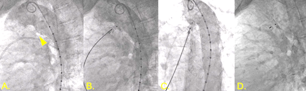 DeBakey CV Education - World Class CV Training (@debakeycvedu) on Twitter photo New #DeBakeyCVJournal case report!
Patent Ductus Arteriosus w/ Left to Right Shunting Exacerbating Aortic Valve Stenosis- <a href="/GangulyPaulamy/">Paulamy Ganguly, MD, MEng</a> Zhihao Zhu, Suhas Babu, Nandan Shettigar <a href="/valeriaduarteMD/">Valeria Duarte MD MPH</a> <a href="/HuieLin/">C Huie Lin MD, PhD 林存暉</a> <a href="/TAMUEnMed/">Texas A&M School of Engineering Medicine</a>
More images doi.org/10.14797/mdcvj…
<a href="/maquinonesmd/">M Quinones MD, MACC</a> <a href="/NadeenFaza/">Nadeen N. Faza, M.D.</a> New #DeBakeyCVJournal case report!
Patent Ductus Arteriosus w/ Left to Right Shunting Exacerbating Aortic Valve Stenosis- <a href="/GangulyPaulamy/">Paulamy Ganguly, MD, MEng</a> Zhihao Zhu, Suhas Babu, Nandan Shettigar <a href="/valeriaduarteMD/">Valeria Duarte MD MPH</a> <a href="/HuieLin/">C Huie Lin MD, PhD 林存暉</a> <a href="/TAMUEnMed/">Texas A&M School of Engineering Medicine</a>
More images doi.org/10.14797/mdcvj…
<a href="/maquinonesmd/">M Quinones MD, MACC</a> <a href="/NadeenFaza/">Nadeen N. Faza, M.D.</a>