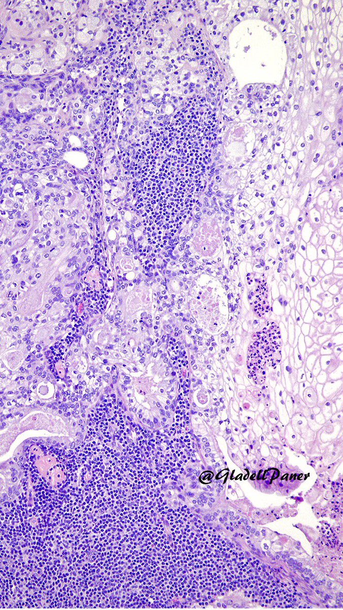 Very rare but diagnosable with #OnePicDx! 🔍

Pelvic lymph node from a radical prostatectomy for #prostate carcinoma. 

What’s your diagnosis on this lymph node metastasis #GUPath tweeps? 

Answer in comment👇🏻👇🏻👇🏻