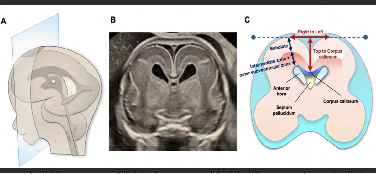 The Fetal Brain Neurosonography in Trisomy 21: the Seagull Sign and Thinned Subplate ow.ly/2RiO50VLa70