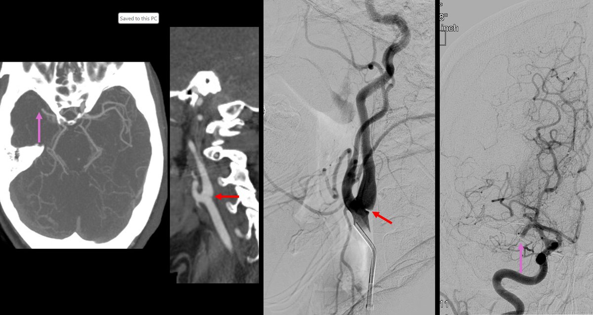 In this patient presenting with an acute occlusion of the mid M1 segment of the right middle cerebral artery (purple arrow), what finding is identified by the red arrow on both the preprocedural CTA and the intraprocedural cervical angiogram? What is the significance?