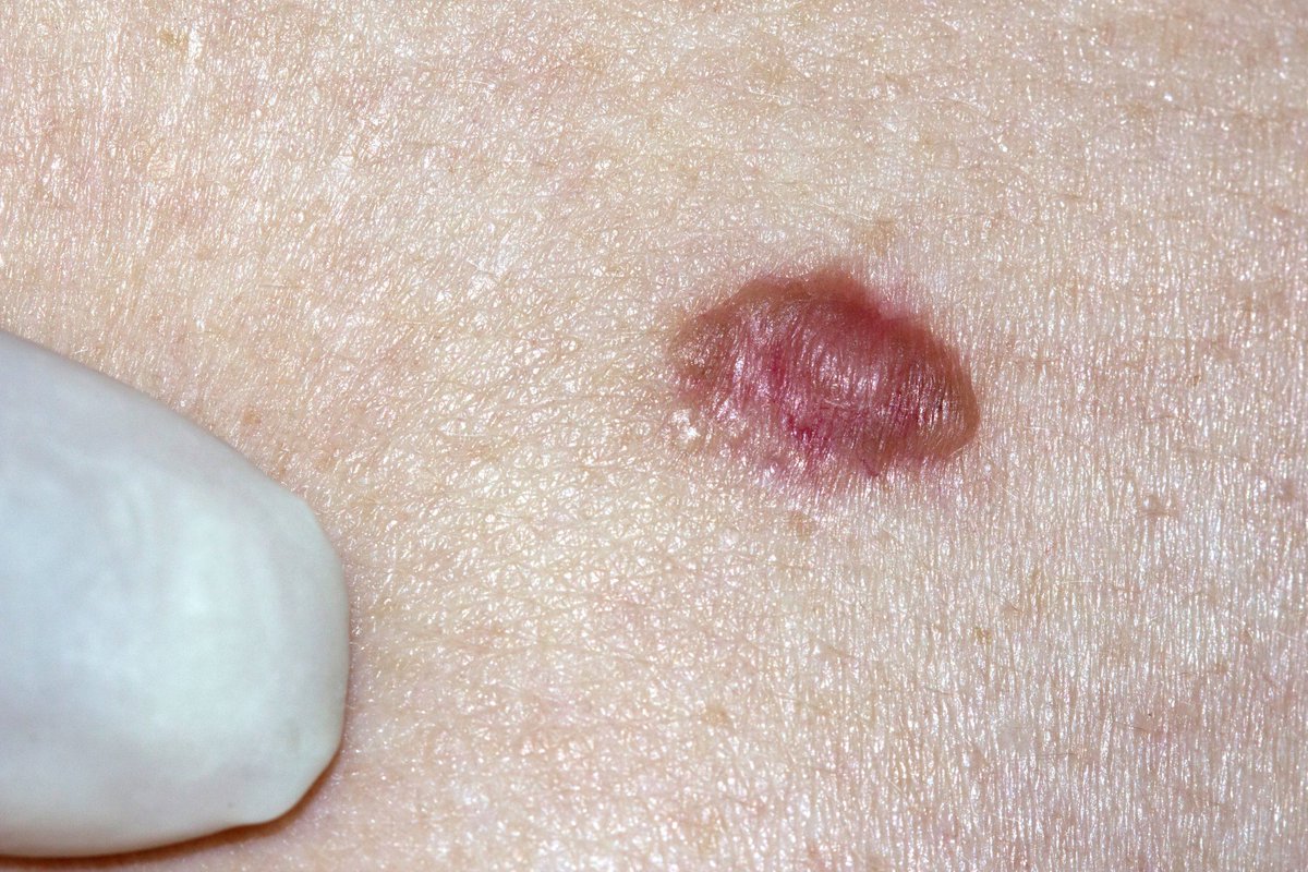 Survivn Overexpression Tied to #BCC Clone Size: jnccn360.org/advanced-skin-… #JNCCN360 #skcsm