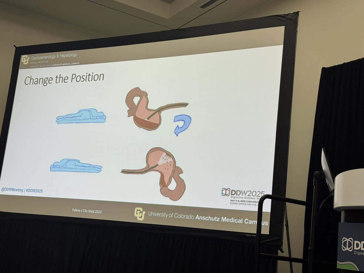 NeenaSAbrahamMD's tweet image. @BilalMohammadMD 
👉🏽 Tools &amp;amp; tricks for endoscopic management of #GIBleeding

🩸Focus on the big 4
🩸You can’t treat what you can’t see— clear clots with BioVac &amp;amp; clot clearing devices
🩸Change patient position to improve visualization