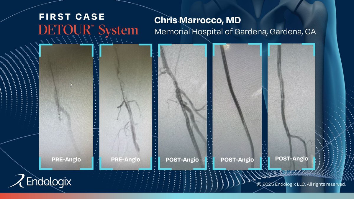Congrats, Chris Marrocco, MD, of Memorial Hospital of Gardena, for completing your first case with the #DETOURSystem. We think it's awesome that you were able to successfully treat this patient with #PTAB after they were referred following a failed retrograde recanalization