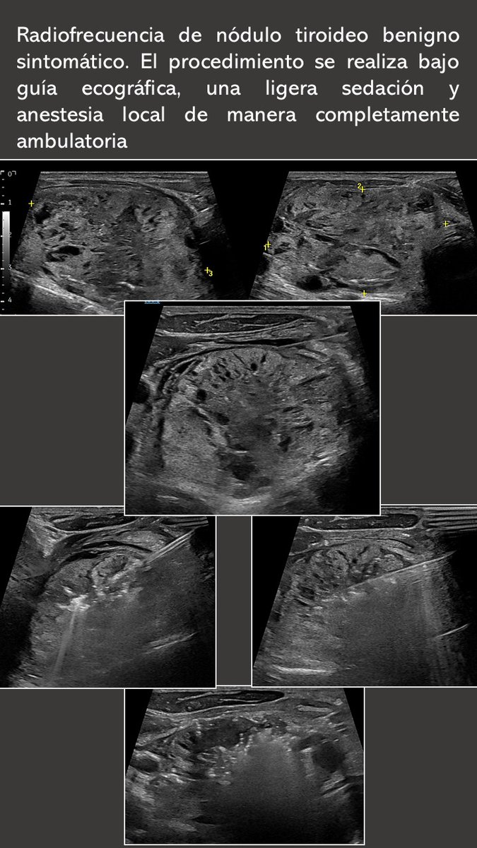 Alberto Alonso Burgos (@aalonsoburgos) on Twitter photo ¿Tratar quistes y #nódulos #tiroideos sin cirugía? Gracias a técnicas como la etanolización o la radiofrecuencia, endocrinólogos y radiólogos intervencionistas trabajamos juntos en <a href="/ClinicaNavarra/">Clínica Universidad de Navarra</a> para ofrecerte el mejor tratamiento personalizado y mínimamente invasivo. ¿Tratar quistes y #nódulos #tiroideos sin cirugía? Gracias a técnicas como la etanolización o la radiofrecuencia, endocrinólogos y radiólogos intervencionistas trabajamos juntos en <a href="/ClinicaNavarra/">Clínica Universidad de Navarra</a> para ofrecerte el mejor tratamiento personalizado y mínimamente invasivo.