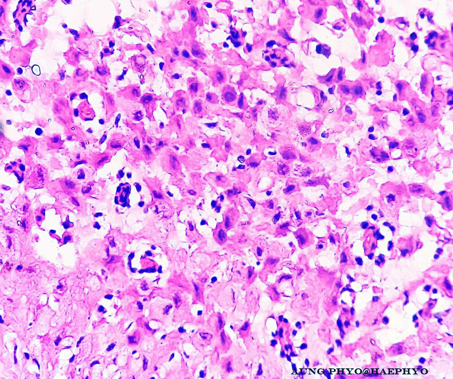 A pregnant lady with rapidly growing nodule in LSCS scar. A lovely example of scar deciduosis. 
#pathology #dermpath #Gynepath #deciduosis