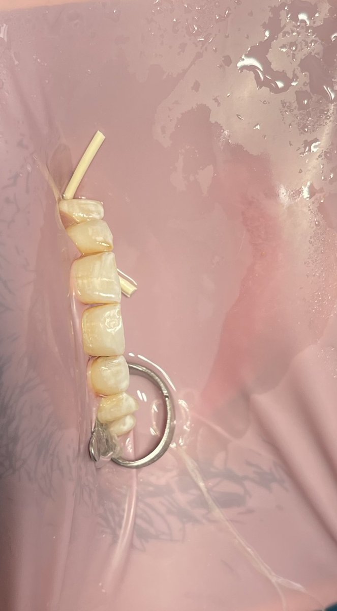 DentRetaj's tweet photo. Distal Class lll restoration on teeth#8🪄🦷
Before and after: https://t.co/t0Tj5s9TOY