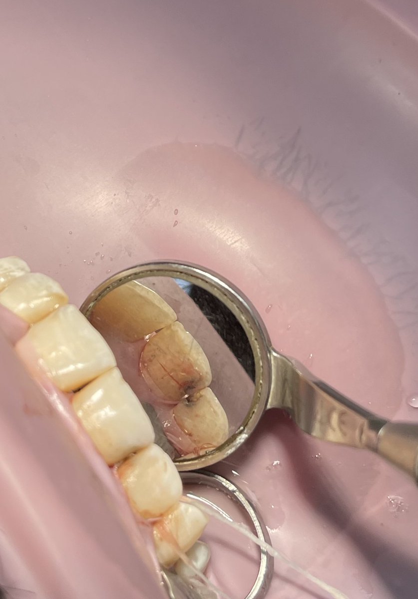 DentRetaj's tweet photo. Distal Class lll restoration on teeth#8🪄🦷
Before and after: https://t.co/t0Tj5s9TOY