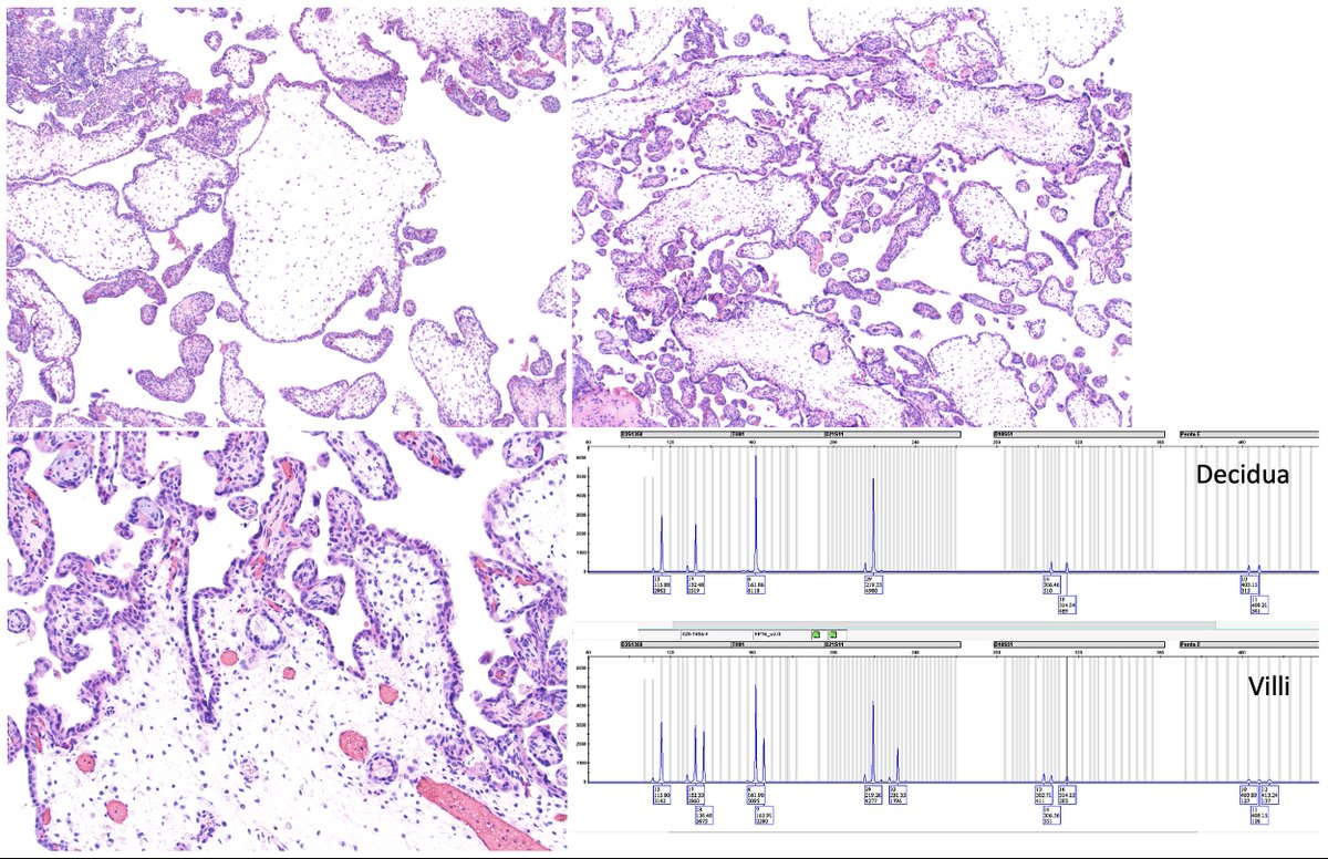 Pei Hui (@hui2pei) on Twitter photo Y-GTD Case of May 2025: Patient in her 30s presenting with fetal demise at 15 weeks of gestation and triploidy upon cytogenetic microarray analysis of the chorionic villi. <a href="/yalepathology/">Yale Pathology</a> bit.ly/48Yq1pO Y-GTD Case of May 2025: Patient in her 30s presenting with fetal demise at 15 weeks of gestation and triploidy upon cytogenetic microarray analysis of the chorionic villi. <a href="/yalepathology/">Yale Pathology</a> bit.ly/48Yq1pO