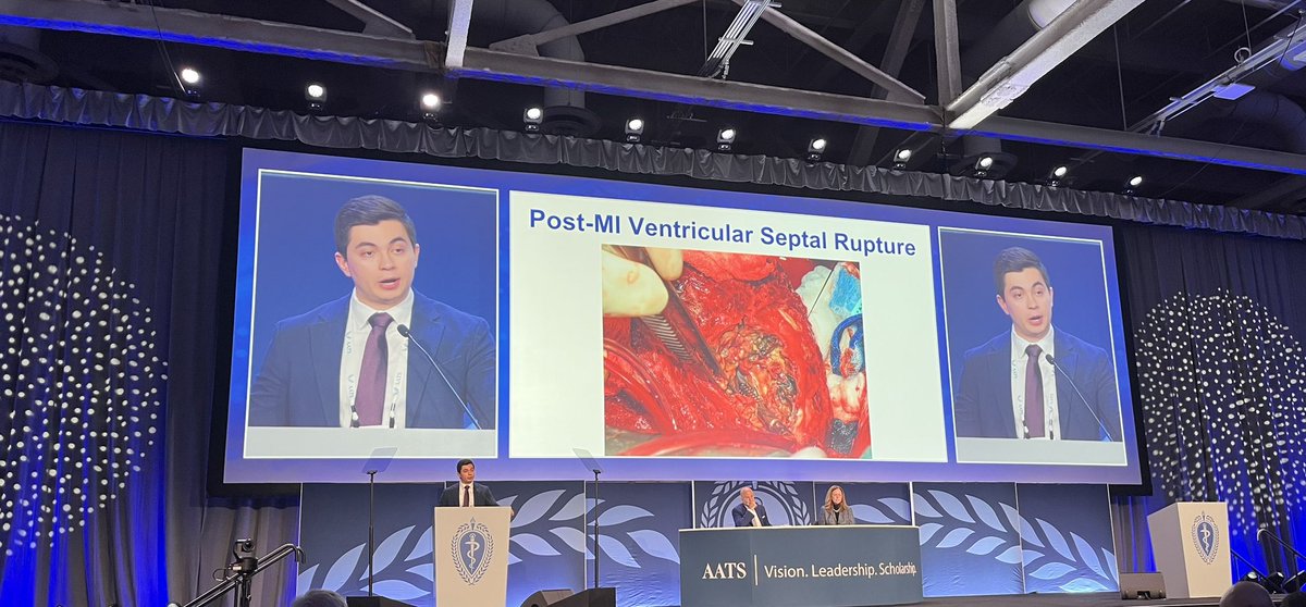 Jonathan Putnam (@putnam_jonathan) on Twitter photo Shout out to <a href="/David_Moros17/">David Moros</a> for his excellent plenary session on CCF’s experience with post-mi septal rupture! Making the team at <a href="/CleClinicHVTI/">Cleveland Clinic Heart, Vascular & Thoracic</a> proud! #aats2025 <a href="/AATSHQ/">AATS</a> Shout out to <a href="/David_Moros17/">David Moros</a> for his excellent plenary session on CCF’s experience with post-mi septal rupture! Making the team at <a href="/CleClinicHVTI/">Cleveland Clinic Heart, Vascular & Thoracic</a> proud! #aats2025 <a href="/AATSHQ/">AATS</a>