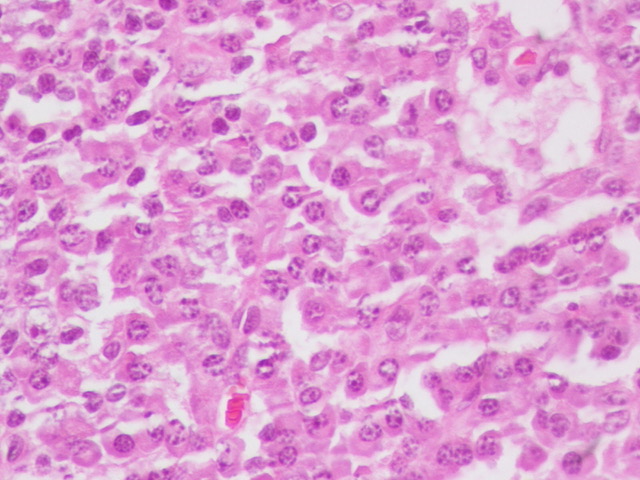 Celina Stayerman MD (@ariella8) on Twitter photo #Hemepath When you get a textbook case 👀😲
Sharing a classic case ,this is just my second case on practice .
Patient with multiple lymphadenopathies and subcutaneous nodules.
Part 1 The lymph node
It will not end here .
<a href="/sanamloghavi/">Sanam Loghavi, MD صنم لغوی 🔬🧬</a> <a href="/Quique_rs/">Quique Revilla</a> <a href="/kis_lorand/">Lorand Kis</a> <a href="/KMirza/">Kamran Mirza MD PhD - کامران مرزا</a> #Hemepath When you get a textbook case 👀😲
Sharing a classic case ,this is just my second case on practice .
Patient with multiple lymphadenopathies and subcutaneous nodules.
Part 1 The lymph node
It will not end here .
<a href="/sanamloghavi/">Sanam Loghavi, MD صنم لغوی 🔬🧬</a> <a href="/Quique_rs/">Quique Revilla</a> <a href="/kis_lorand/">Lorand Kis</a> <a href="/KMirza/">Kamran Mirza MD PhD - کامران مرزا</a>