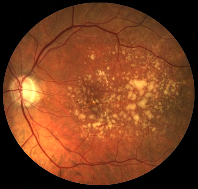 Fish Oil Doesn’t Lower AMD Risk

ARVO study shows lifestyle changes such as quitting smoking can have a bigger impact on eye health than omega-3 fatty acids.
reviewofoptometry.com/article/fish-o…
#AMD #maculardegeneration