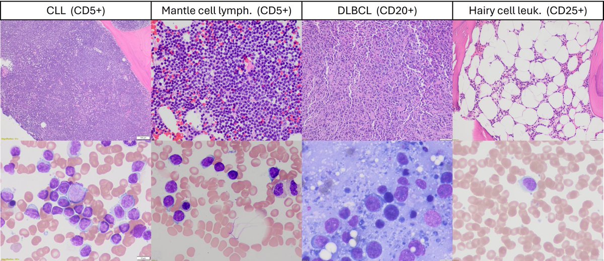 If B cell lymphomas had a calendar today 📆 … 05/05/20 25  😉
a #hemepath #CincoDeMayo #MetGala post
📍CLL (CD5)
📍Mantle cell lymphoma (CD5)
📍DLBCL (CD20)
📍Hairy cell leukemia (CD25)
#Nerdy…. I admit 🤓 even for a pathologist! 🙈
#IYKYK