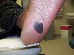 In #skinofcolor, #melanoma is often found in places that don't usually see the sun: soles of feet, palms, nails, inside the mouth.  When melanoma occurs in ppl of color, it’s often found at a later stage, which can lead to poorer outcomes. See your derm! bit.ly/MelanomaSOC