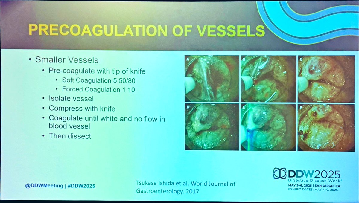 Jan Král (@kraljan) on Twitter photo No bleeding, no problem! 🛑
Pre-coagulate small vessels before cutting:
🔪 Isolate
🔪 Compress
⚡ Coagulate till white
✅ Then dissect
👏🏻 Great speach by <a href="/amitbhattMD/">Amit Bhatt MD</a>
#EndoTips #ddw2025 <a href="/DDWMeeting/">Digestive Disease Week</a> <a href="/ASGEendoscopy/">ASGE GI Endoscopy</a> <a href="/ESGE_news/">ESGE</a> <a href="/AmerGastroAssn/">American Gastroenterological Association (AGA)</a> <a href="/ClevelandClinic/">Cleveland Clinic</a> No bleeding, no problem! 🛑
Pre-coagulate small vessels before cutting:
🔪 Isolate
🔪 Compress
⚡ Coagulate till white
✅ Then dissect
👏🏻 Great speach by <a href="/amitbhattMD/">Amit Bhatt MD</a>
#EndoTips #ddw2025 <a href="/DDWMeeting/">Digestive Disease Week</a> <a href="/ASGEendoscopy/">ASGE GI Endoscopy</a> <a href="/ESGE_news/">ESGE</a> <a href="/AmerGastroAssn/">American Gastroenterological Association (AGA)</a> <a href="/ClevelandClinic/">Cleveland Clinic</a>