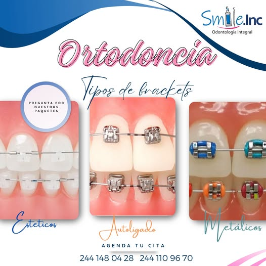HechosdeAtlixco's tweet image. #Brackets | 😃 ¿Qué tipo de brackets son los que puedo usar? 

Bueno, en Smile.inc nos comentan que depende de las prioridades del paciente y tratamiento será el tipo de bracket a elegir:
✅️Metálicos
Estéticos o cerámicos
✅️Autoligado