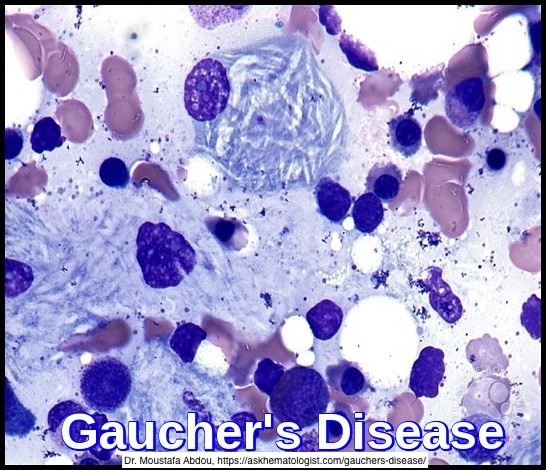 Path4People's tweet image. Gaucher v. Niemann-Pick.  

Both involve Macrophages + 🧬 AR

Former: Glucocerebroside ⬆️; Looks like CRUMPLED tissue paper

Latter: Sphingomyelin ⬆️; FOAMY, VACUOLATED cytoplasm

#pathx #genetics #hemepath #heme #medicalstudent #pathtwitter #pedsx